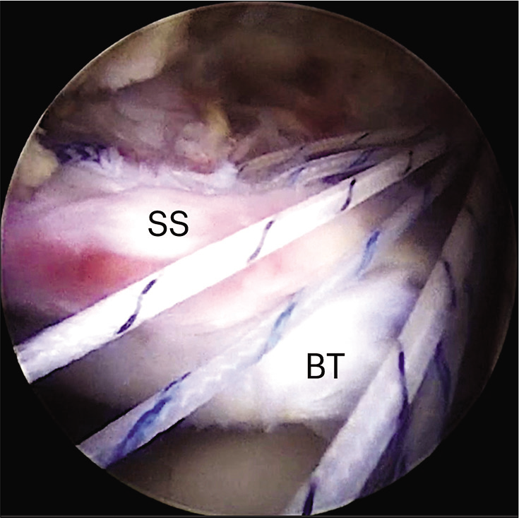 Arthroscopic superior capsular reconstruction and cuff augmentation using the biceps autograft are demonstrated (SS: Supraspinatus, BT: Long biceps tendon).