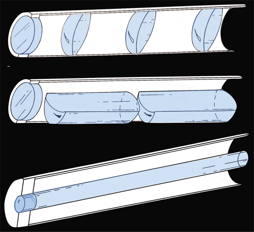Early lenses were based on telescopes, with convex lens separated by air. The development of the rod lens allowed more light to be transmitted through a thinner diameter, enabling miniaturization of scopes for use in small joints. Adapted from Arthroscopic surgery: Principles and practice, 3rd edition, Johnson LL, p. 1481, Copyright 1986, with permission from The C.V. Mosby Company.