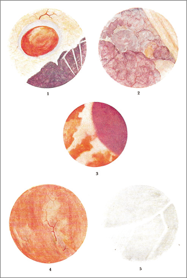 The first edition of Watanabe’s Atlas of arthroscopy featured hand painted depictions of the view down the arthroscope, as Watanabe believed that the photos were not of adequate quality.[102] In later editions, Watanabe included photos taken through the arthroscope. Reprinted from Atlas of Arthroscopy, 3rd edition, Watanabe M, Takeda S, Ikeuchi H, History of Arthroscopy, p. 10, Copyright 1979, with permission from Springer.[2]