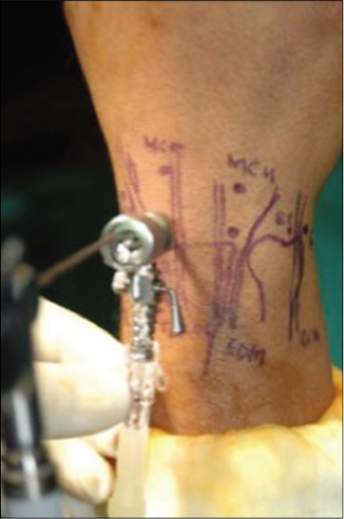 Dorsum of the wrist showing established portal markings and the 3–4 portal with scope inserted.