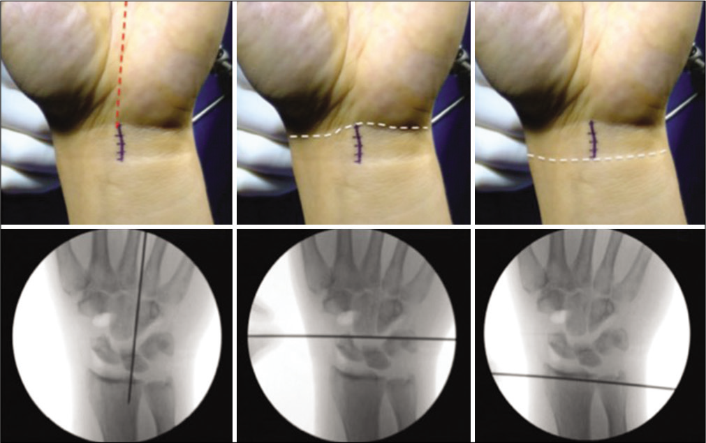 The volar central portal as described by Fernando Corella. A 1.5 cm incision made from distal to proximal wrist crease in line with the 3rd intermetacarpal space, with corresponding radiographs shown below each landmark (reprinted with permission from F Corella).