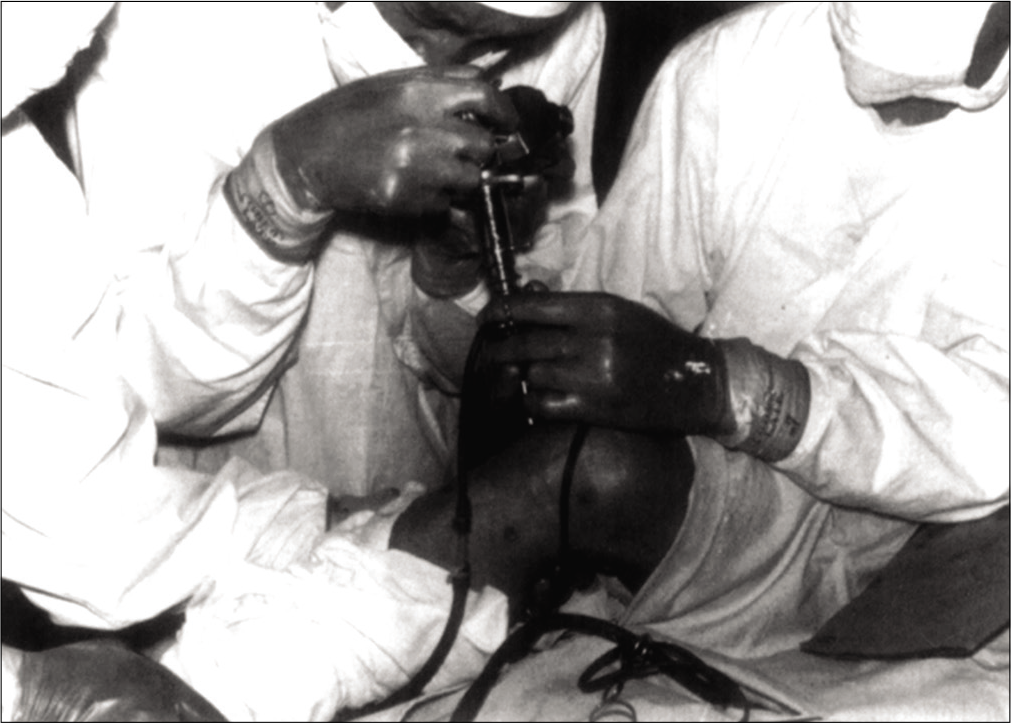 Dr. Burman performing an arthroscopic procedure at the Hospital for Joint Diseases in 1935. Source: Byrd 2013– Springer “Overview and History of Hip Arthroscopy” in book “Operative Hip Arthroscopy” ISBN 978-1-4419-7925-4.