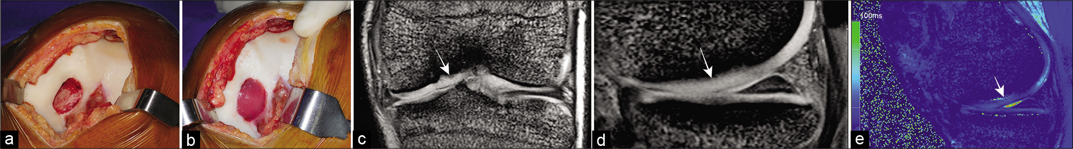 (a) Large osteochondritis dissecans (OCD) of medial femoral condyle of knee, (b) fibrin autologous chondrocyte implantation (ACI) cartilage repair, (c) and (d) 2-year follow-up MRI reveals a successful cartilage repair with MOCART score of 95, (e) T2 cartilage map performed 2 years after implantation reveals a hyaline rich cartilage repair (white arrows denote the cartilage repair site in c,d,e).