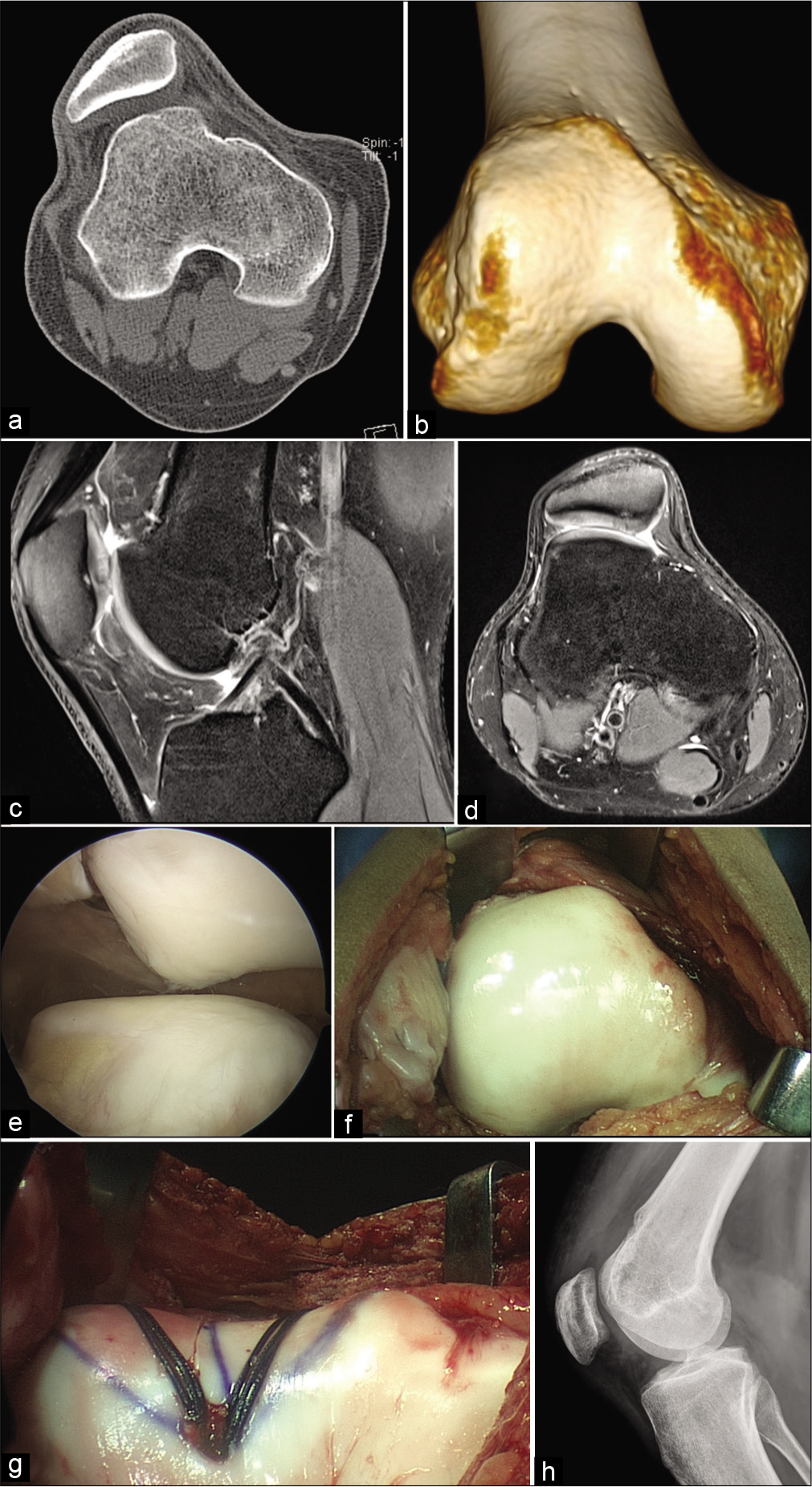 Recurrent patellar lateral dislocations with severe trochlear dysplasia and MPFL tear. (a) CT scan axial cut reveals a Dejour Type 4 trochlear dysplasia, (b) 3D CT scan further defines the bony deformity, (c) MRI sagittal cut reveals the supratrochlear spur, (d) MRI axial cut demonstrates patellar chondral status, (e) arthroscopic evaluation from superolateral portal reveals lateral patellar mal-tracking with trochlear dysplasia and minimal patellar chondral lesion, (f) an open exposure for trochleoplasty is performed, (g) groove deepening trochleoplasty is completed with lateralization of the trochlear groove to compensate for increased tibial tubercle to trochlear groove distance, (h) post- operative lateral radiograph at 3 months reveals healing of trochleoplasty with anatomical femoral insertion site for MPFL reconstruction.