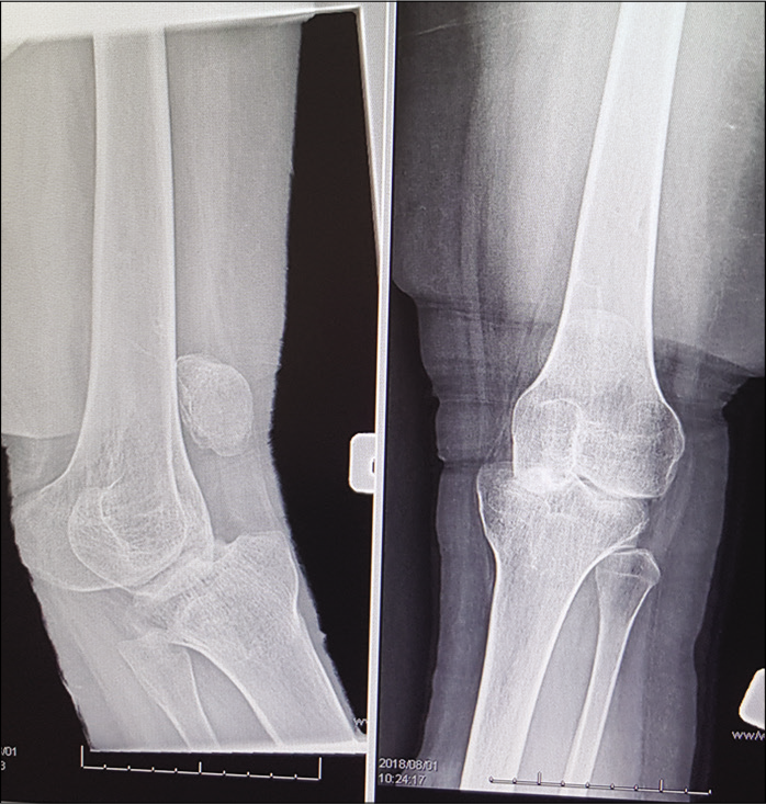 X-rays of a chronic knee dislocation treated in a rural South African hospital. Regular radiographic must be done when treating patients nonoperatively to avoid this at all costs.