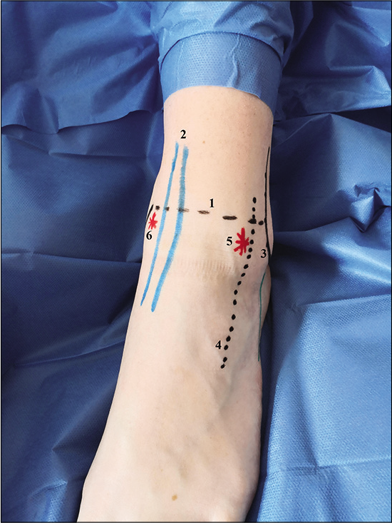 Anterior ankle portals with landmarks. 1 = Ankle joint line, 2 = tibialis anterior tendon, 3 = lateral malleolus, 4 = superficial peroneal nerve, 5= anterolateral portal, 6= anteromedial portal.
