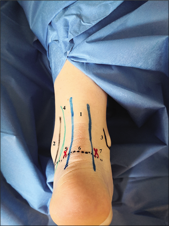 Posterior portals and landmarks. 1 = Achilles tendon, 2 = lateral malleolus, 3 = medial malleolus, 4 = peroneal tendons, 5 = posterolateral portal, 6 = line from tip of lateral malleolus, 7 = posteromedial malleolus.
