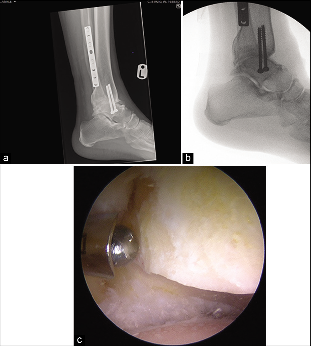 (a) Weight-bearing lateral view radiograph of left (L) ankle showing post traumatic bony spurs at anterior lip of distal tibia and dorsal aspect of neck of talus causing anterior ankle impingement. (b) Intraoperative fluoroscopy picture following resection of anterior ankle spurs demonstrating adequate excision. (c) Intraoperative arthroscopy view of ankle joint from lateral portal demonstrating adequate excision of distal tibial anterior bone spur using a burr.