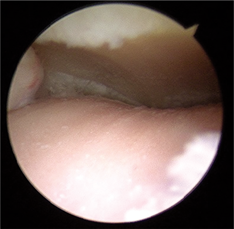Intraoperative arthroscopy view of ankle joint from the medial portal demonstrating complete chondral loss along with eburnation of talar dome.
