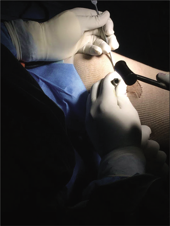 Harvesting cancellous graft from ipsilateral proximal using OATS bone harvest handle.