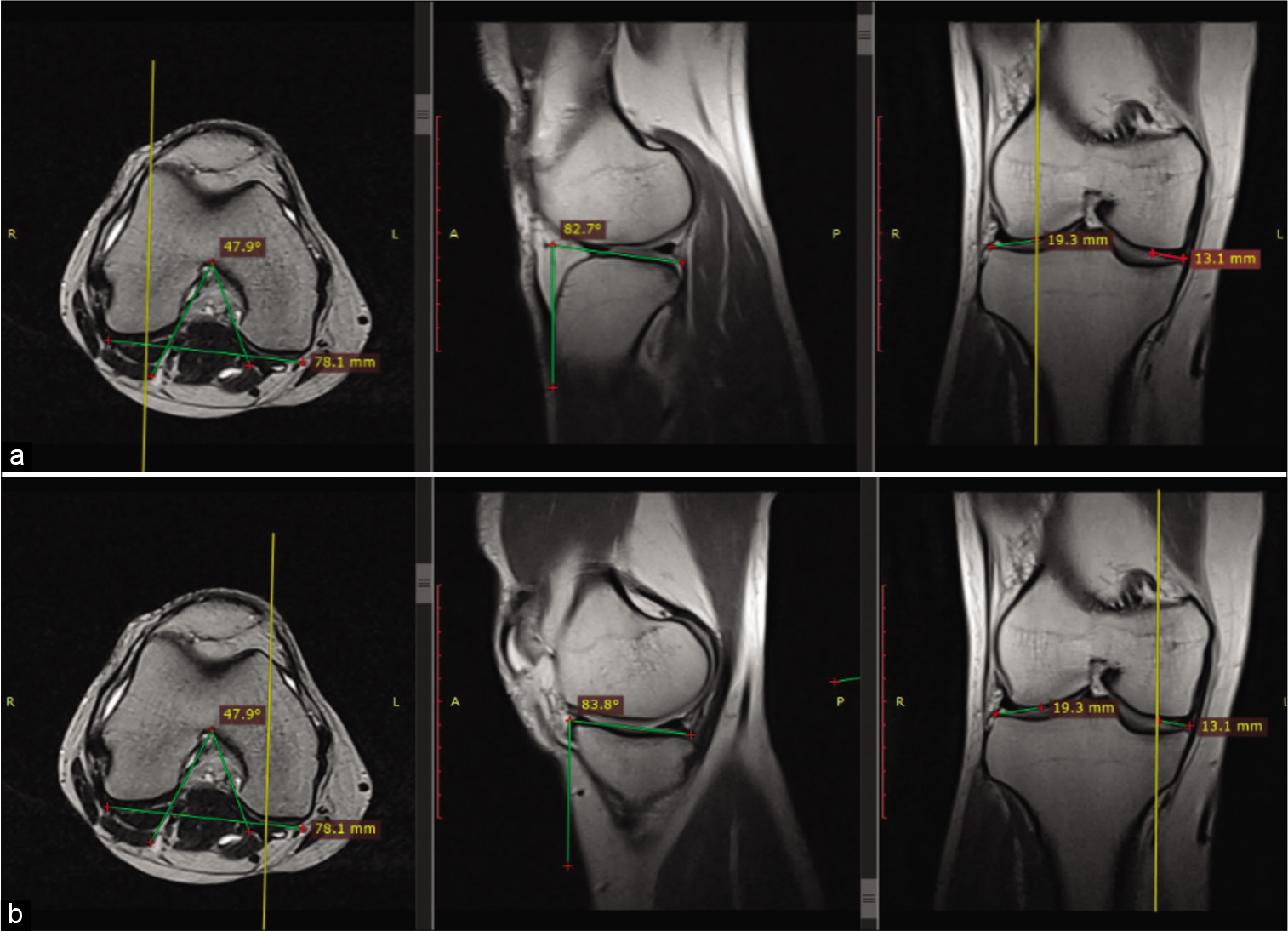 Illustrating the method used to measure (a) posterior tibial slope in the lateral compartment (b) posterior tibial slope in the medial compartment.