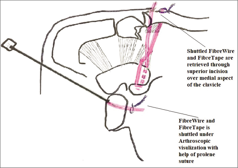 Schematic diagram showing shuttling of FiberWire and FiberTape to clavicle medial fracture fragment under arthroscopic visualization.