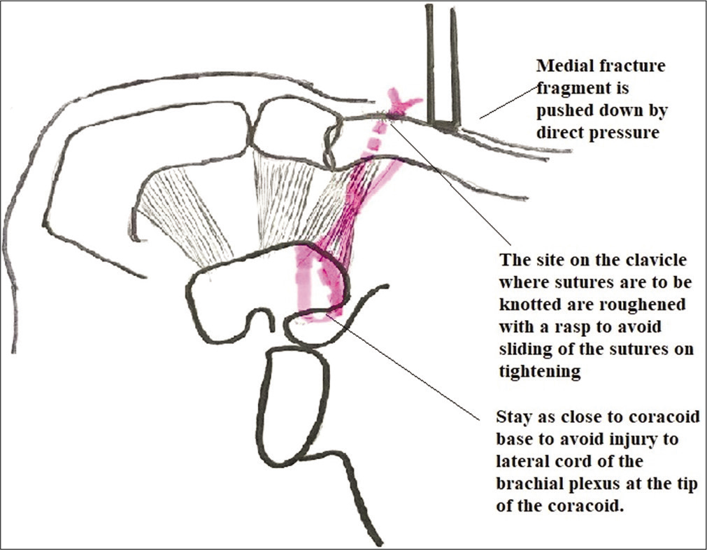 Schematic diagram showing final knotting of the FiberWire and tape over medial fracture fragment of clavicle.