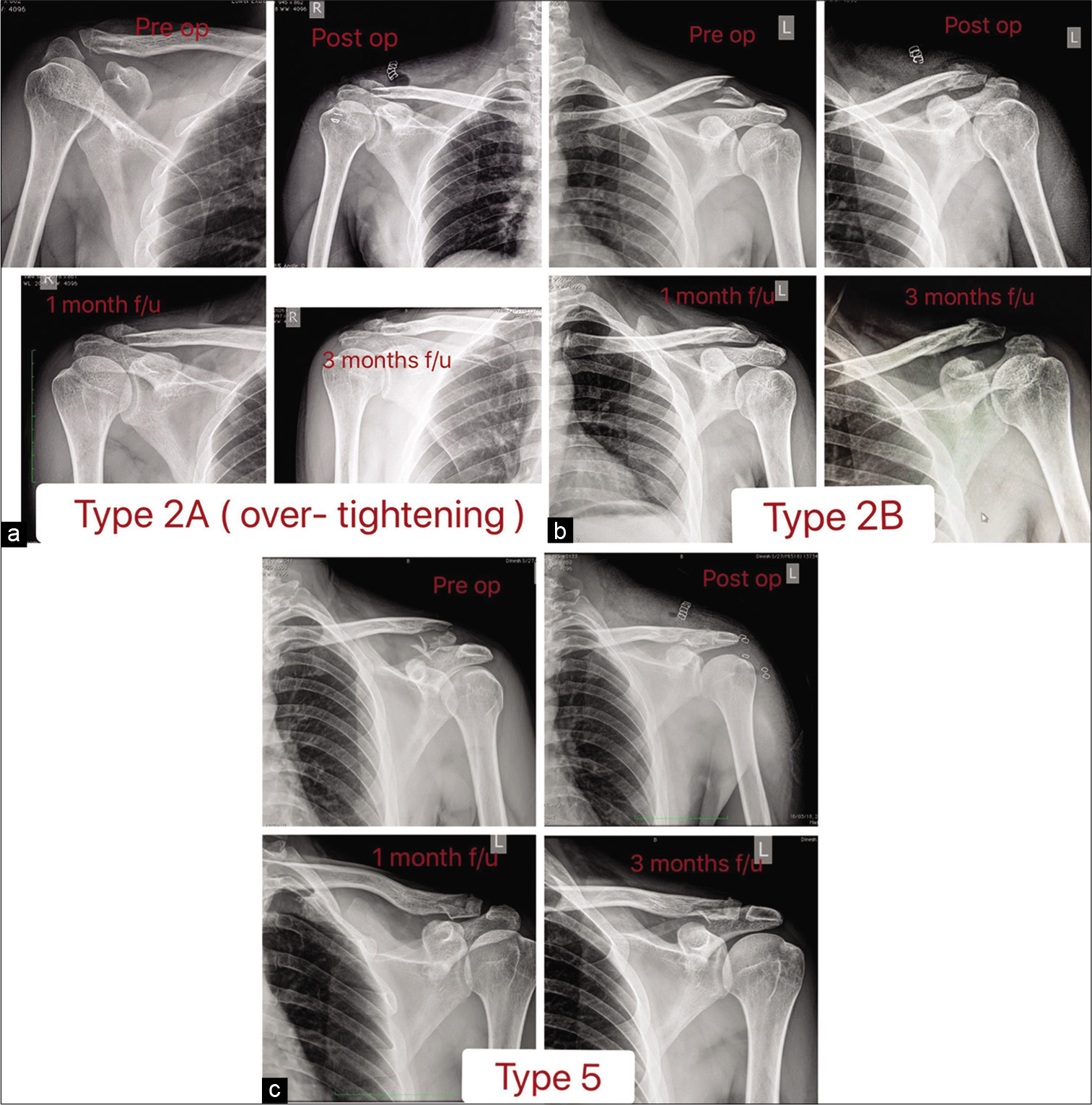 (a) Follow-up of Neer type 2A (displaced fracture with intact conoid and trapezoid ligament). showing mal reduction due to over-tightening. (b) Follow-up of Neer type 2B (displaced fracture with torn conoid ligament). (c) Follow-up of Neer type 5 (comminuted fracture pattern).