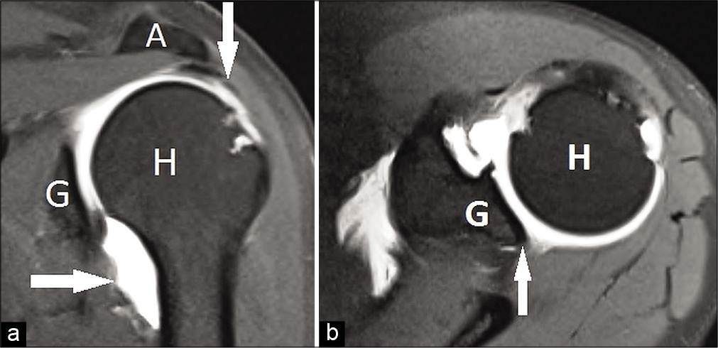 (a) Pre-operative coronal magnetic resonance imaging (MRI) scan. Rotator cuff lesion is shown with white arrows under the acromion (A). Humeral avulsion of the glenohumeral ligament lesion is shown with white arrow between glenoid (G) and humeral head (H). (b) Pre-operative axial MRI scan. Deficiency of posterior labrum is pointed with white arrow between glenoid (G) and humeral head (H).