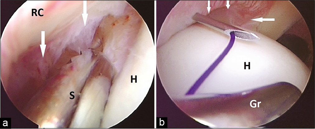 (a) Partial articular infraspinatus tendon avulsion lesion is shown with white arrows. A shaver (S) is shown preparing the margin of lesion between intact tendon (RC) and humeral head (H). (b) Technique of partial articular infraspinatus tendon avulsion repair. Lesion is shown with white arrows. A transtendinous needle was used to pass PDS suture which was retrieved using grasper (Gr). Later, sutures from the anchor were shuttled over the PDS. Two mattress stitches were thus prepared.