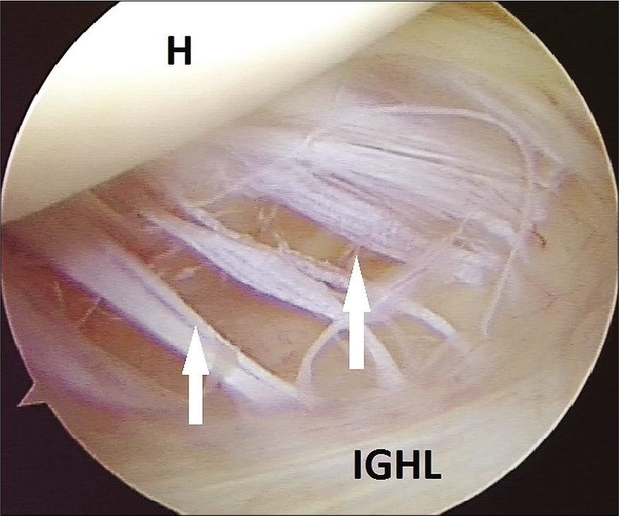Humeral avulsion of the glenohumeral ligament lesion is shown with white arrows. Note the humeral head (H) above and the intact part of anterior inferior glenohumeral ligament below. IGHL - Inferior glenohumeral ligament