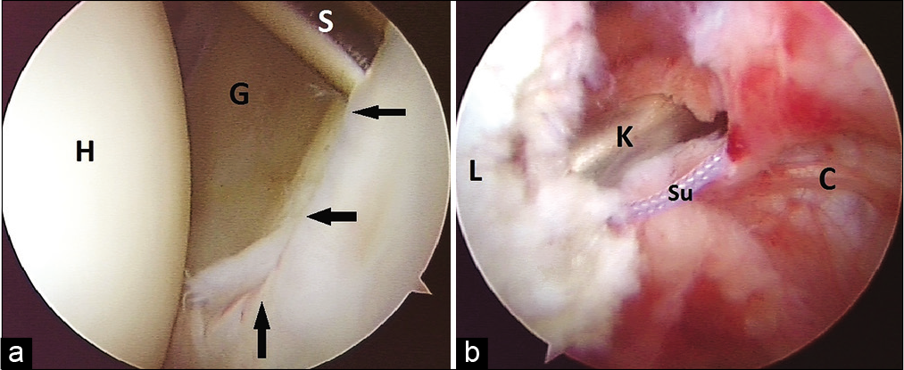 (a) Posterior labral tear (black arrows) as viewed from the posterior portal. Glenoid (G) and head (H) are marked. Shaver (S) was used to prepare the bed for repair. (b) Posterior labral repair as viewed from the anterior portal. Sutures (Su) are tied over the labrum (L) using a knot pusher (K). The posterior capsule (C) is also seen.