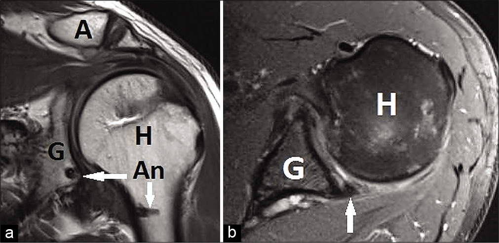 (a) Six months post-operative coronal magnetic resonance imaging (MRI) scan with white arrows showing two anchors (An) in glenoid (G) and humerus. Healed rotator cuff is seen under acromion (A). Note that the axillary pouch volume is quite reduced as compared to pre-operative (Figure 1a). (b) Six months postoperative axial MRI scan with white arrow showing healed posterior labrum. Glenoid (G) and humeral head (H) are marked.