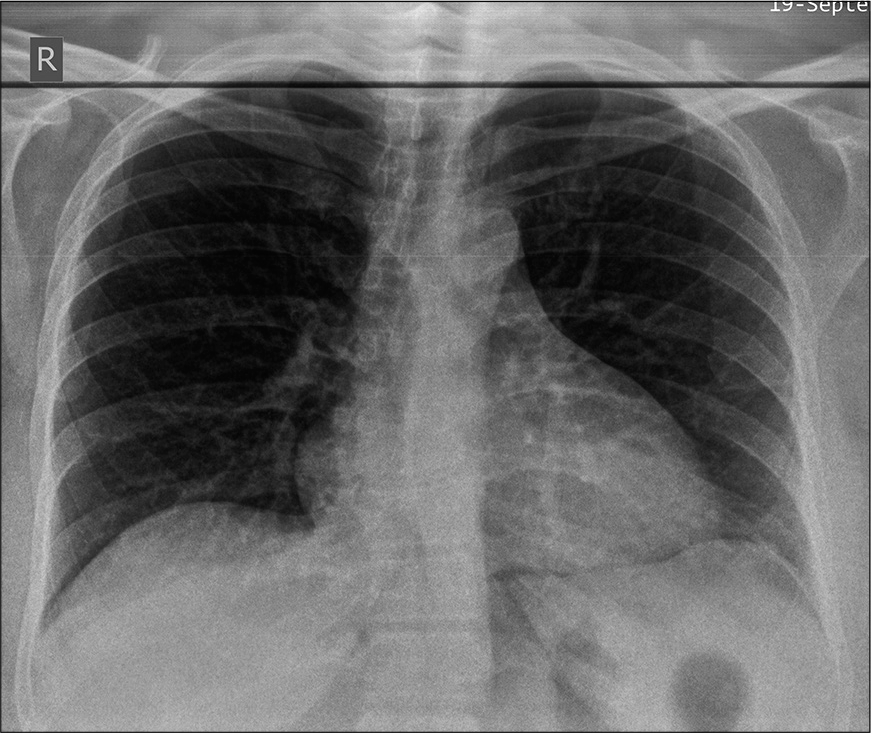 Magnetic resonance imaging of the shoulder revealing a type 2 and slanting acromion with supraspinatus tendinosis (white arrow – slanting acromion; yellow arrow – type 2 acromion).