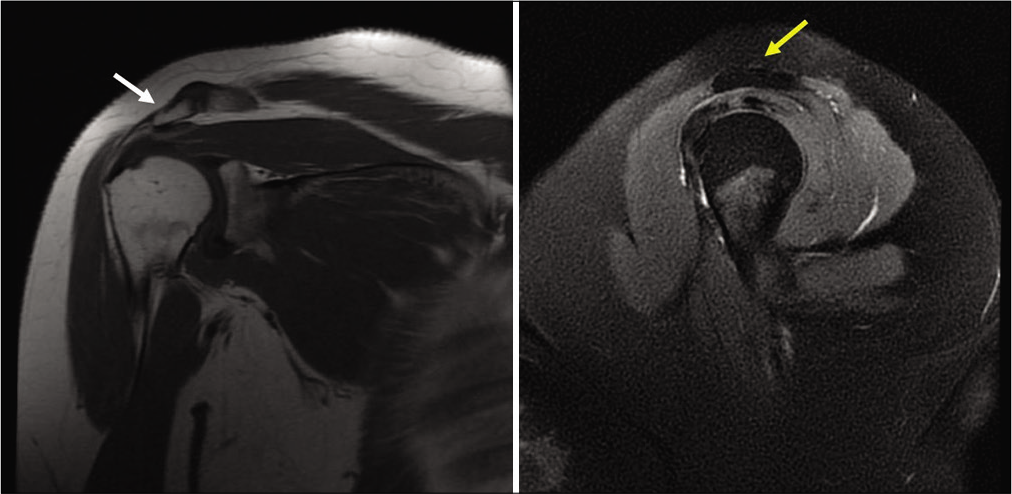 Normal pre-operative anteroposterior chest radiograph (white arrow - slanting acromion; yellow arrow - type 2 acromion).