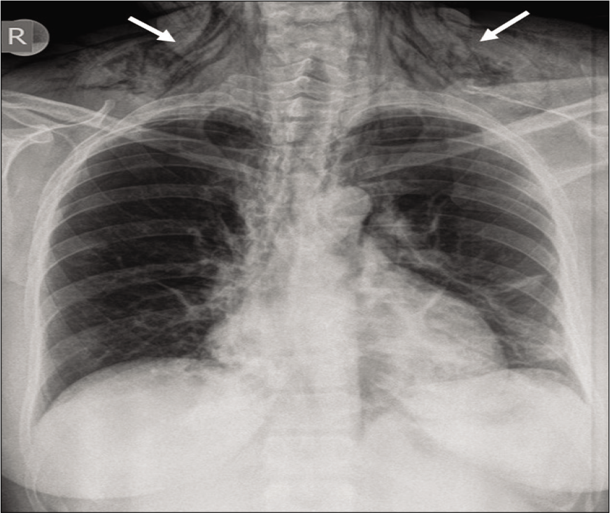 Post-operative anteroposterior chest radiograph showing striations, a characteristic sign of subcutaneous emphysema (white arrows).