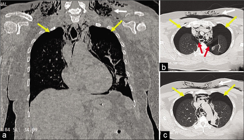 Coronal section (a) and axial sections (b and c) of computed tomography showing subcutaneous emphysema (white arrows), bilateral pneumothorax (yellow arrows) and pneumomediastinum (red arrows).