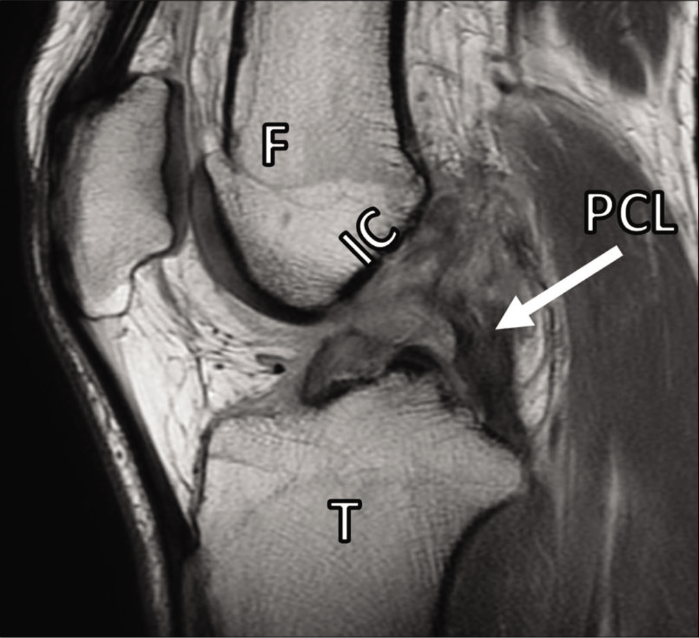 Journal of Arthroscopic Surgery and Sports Medicine The Posterior ...