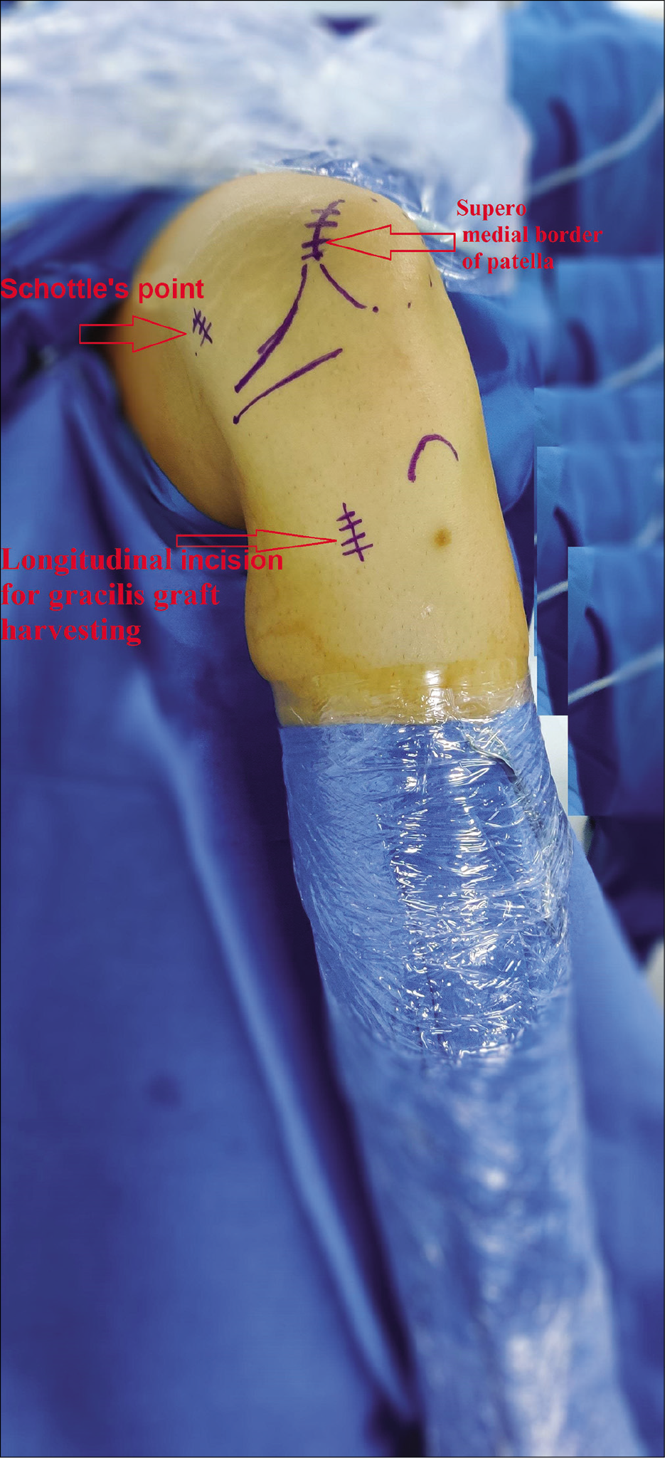 A 27-year-old man who presented with recurrent patellar dislocation in his left knee. He was planned for medial patellofemoral ligament reconstruction. Landmarks were drawn after painting and draping. Schottels point, Superomedial border of patella and Longitudinal incision for gracilis graft harvesting are shown by arrows.