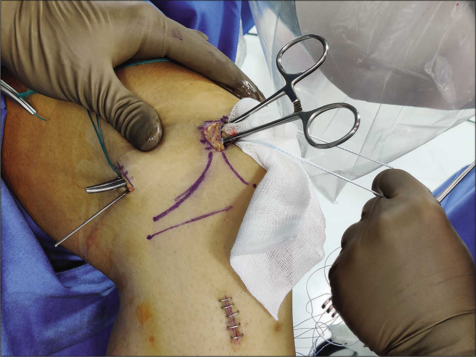 Graft passage preparation by dissecting under the vastus medialis oblique till the medial epicondyle. Artery forceps seen here are passed between the superficial medial collateral ligament and capsular layer.