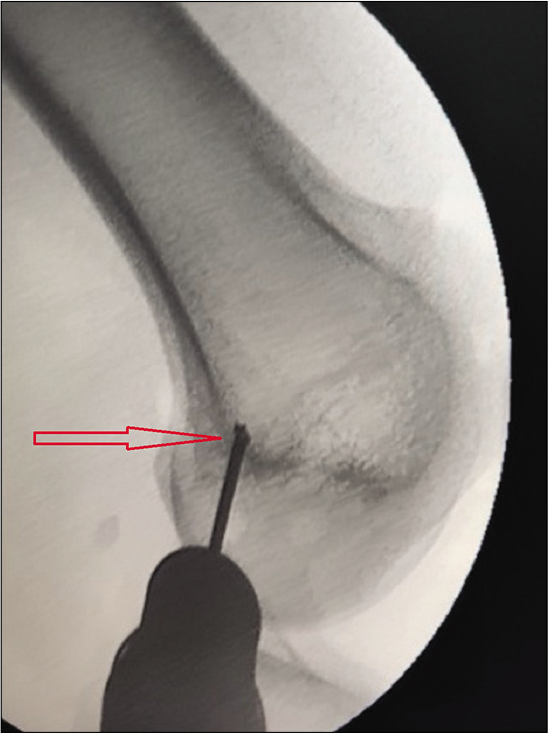 The view of image intensifier showing the isometric point (marked by the arrow) between adductor tubercle and medial epicondyle at which the guide wire is drilled for creating the bony tunnel for passing the graft, using Schöttle technique.