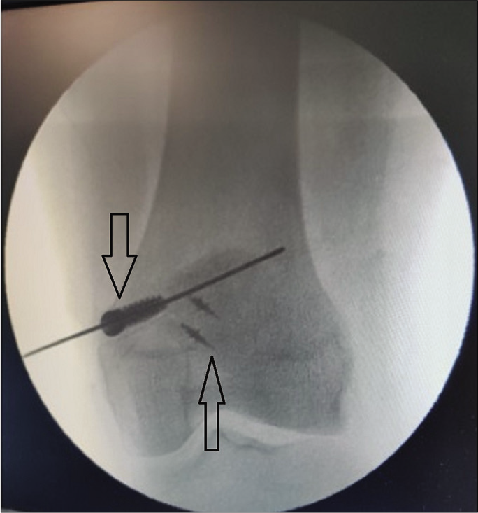 Implant position confirmation image through fluoroscopy. Arrows mark the RCI interference screw in femur and the suture anchors in superomedial quadrant of patella.