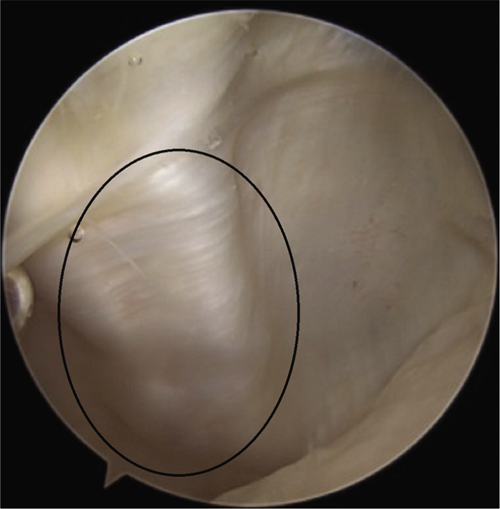 Graft visualization by arthroscopy – the extra-synovial position as shown in circle.