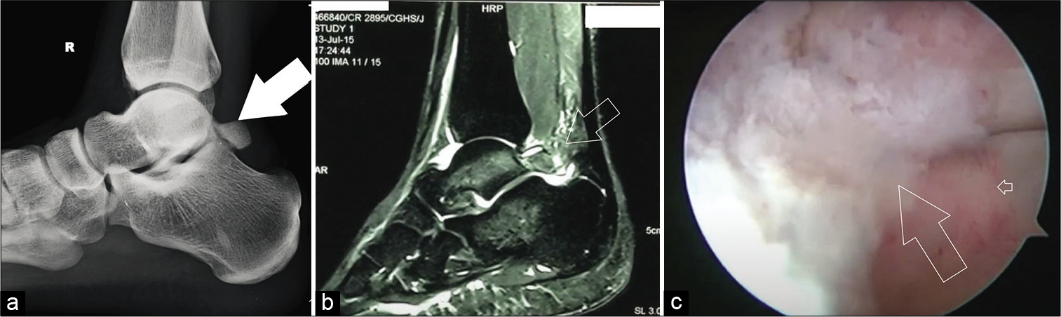 (a) Lateral ankle radiograph with associated osteophytes from the posterior tibial plafond (solid arrow), (b) Sagittal magnetic resonance imaging showing posterior impingement lesion (outlined arrow), and (c) arthroscopic view of posterior impingement lesion before debridement (outlined arrow).