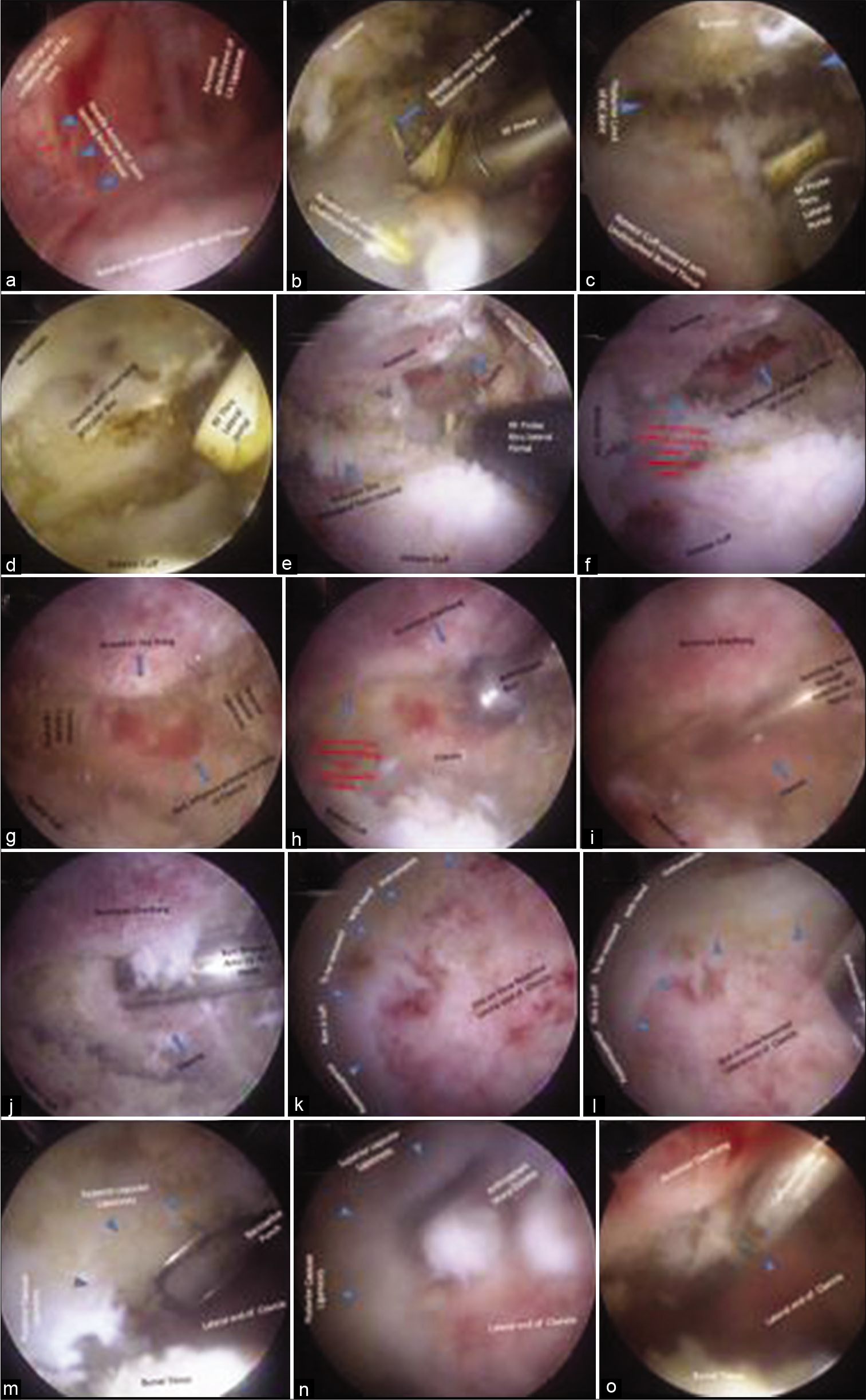 (a and b) Needle localized in subacromial space to restrict ablation to AC joint. (c and d) AC Joint view without and with clavicle pressed down (e and f) View of minimally shaved acromial overhang and inflamed lateral end of clavicle (g) view with 700 scope. (h) Clavicle resection thru lateral portal, (i) anterior ACJ portal, (j) clavicle resection thru anterior portal, (k and l) posterosuperior rim left unviolated during motorized resection, (m and n) posterosuperior rim removal with punch and curette, (o) calibrated probe measurement of length of resection.