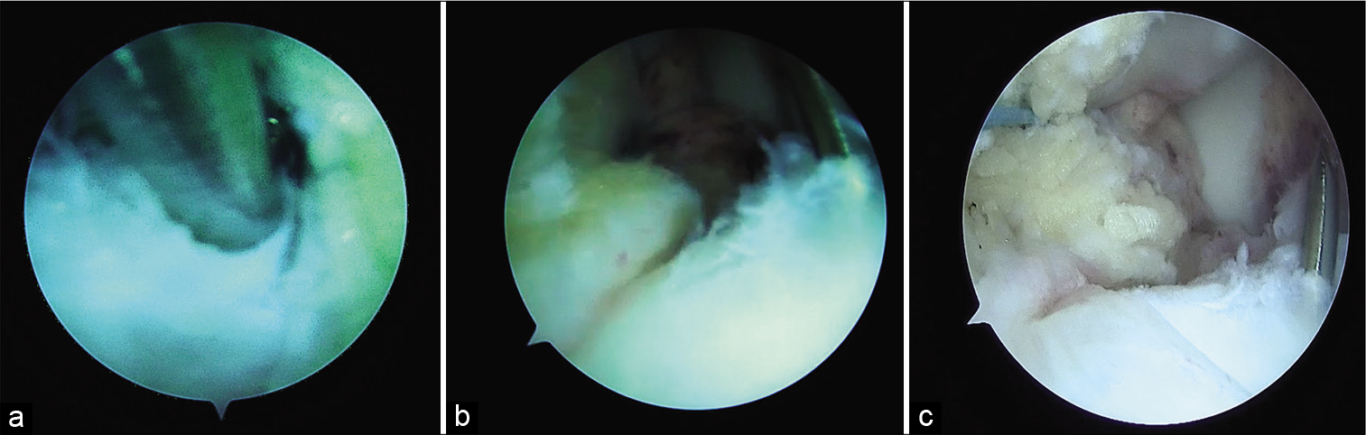 Intra-articular view. (a and b) Need for scope to place close to wire to avoid fat pad from blocking view (a: Proximity of fat pad from 2 O’clock to 5 O’clock position), (c) Ethibond suture is seen retracting the partially excised fat pad at 10 O’clock position and giving a clearer view and space.