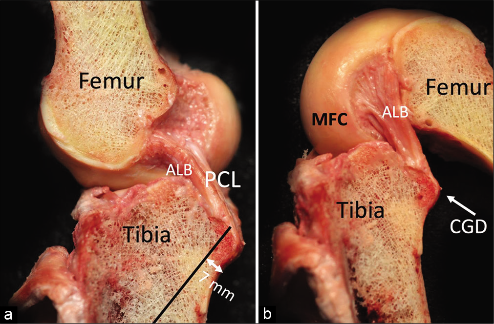 Orientation of the posterior cruciate ligament (PCL) fibers in extension and in flexion. The fibers of the anterolateral bundle (ALB) are more horizontal in extension (a) and vertical in flexion (b). By contrast, the posteromedial bundle (PMB) fibers are more vertical in extension and horizontal in flexion. MFC: Medial femoral condyle.