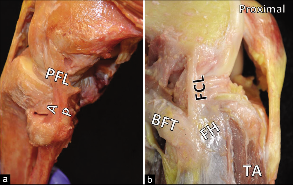 Additional features of the posterolateral corner (PLC). In Part (a), the anterior (A) and posterior (P) divisions of the popliteofibular ligament are evident. Part (b) shows the anterior arm of the biceps femoris tendon obscuring the insertion of the fibular collateral ligament on the lateral fibular head. The proximal tibialis anterior is also visible and makes plain the danger to anterior compartment musculature if the tibial tunnel is malpositioned during PLC reconstruction.