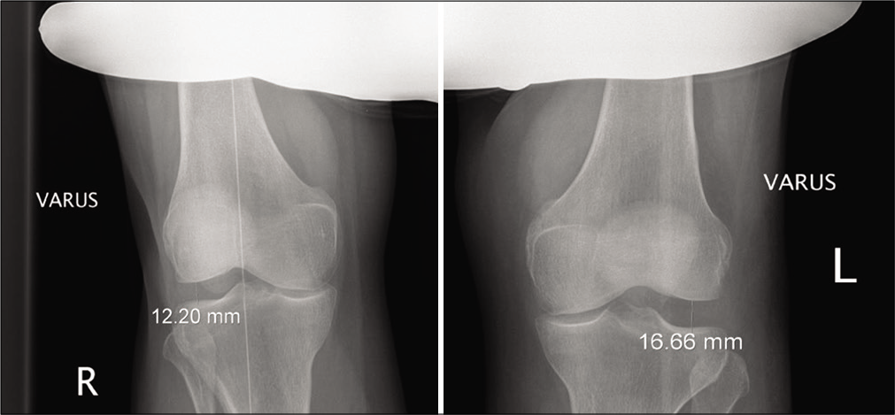 Varus stress radiographs. Varus stress radiography is a validated tool for evaluating injuries of the posterolateral corner. A greater than 2.2 mm side-to-side difference in varus gapping between extremities indicates an isolated fibular collateral ligament tear. A difference in varus opening of >4 mm from one knee to the other indicates a complete posterolateral corner tear.