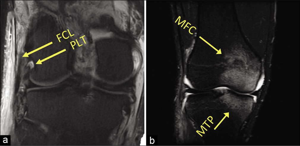 Magnetic resonance imaging (MRI) assessment of posterolateral corner (PLC) injuries. MRI has a high sensitivity and specificity for the detection of Grade III (complete) PLC injuries in the acute setting. (a) A coronal T2-weighted MRI of a left knee. Attenuation of the fibular collateral ligament and avulsion of the popliteus tendon can be seen (arrows). In (b), a common radiographic sign of acute PLC injuries can be seen. Up to 55% of PLC tears demonstrate an anteromedial bone bruise, and this coronal T1-weighted fat-suppressed MRI image demonstrates increased signal in the medial femoral condyle and medial tibial plateau.