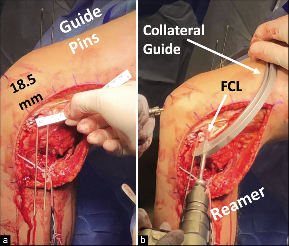 (a and b) Creating tunnels for the fibular collateral ligament (FCL) and popliteus tendon (PLT) grafts in the femur. The anatomic attachment of the FCL on the lateral femoral condyle is 18.5 mm on average posterior to the PLT tendon attachment in the popliteal sulcus (ruler in a). During anatomic posterolateral corner reconstruction, a guide pin is first placed through the femoral attachment of the popliteus tendon. After the correct distance is verified, a guide pin is placed for the FCL femoral tunnel. When correct positioning of both pins is verified, a 9 mm reamer is then used to create FCL and PLT graft tunnels to a depth of 25 mm. A collateral ligament guide (b) is useful in overreaming the guide pins.