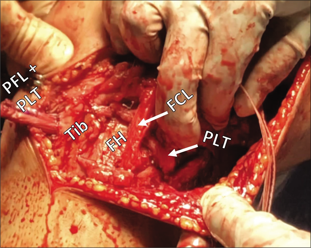 Intraoperative view of anatomic posterolateral corner (PLC) reconstruction. Anatomic reconstruction of the PLC uses two grafts to restore three structures: The fibular collateral ligament (FCL), the popliteus tendon (PLT), and the popliteofibular ligament (PFL). The FCL graft passes anterolaterally to posteromedially through the fibular head tunnel and, along with the PLT, is passed posterior to anterior through a tibial (Tib) tunnel. After fixation in the fibular head, the remainder of the FCL graft serves as a PFL graft and stabilizes the proximal tibiofibular joint.
