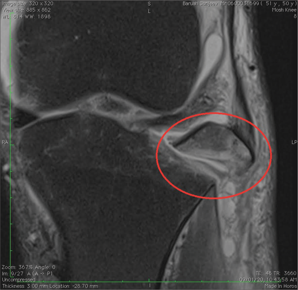 MRI showing the fracture fragment.