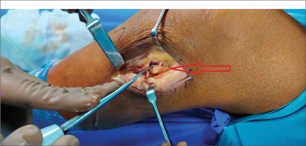 Intraoperative picture showing the fragment marked by arrow.