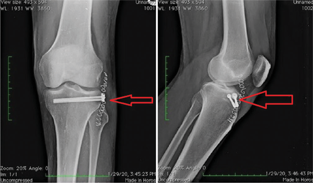 Post-operative X-ray: AP and lateral showing fixation marked by arrow.