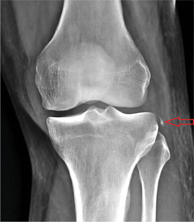 Segond fracture – tibial avulsion of LCL marked by arrow.