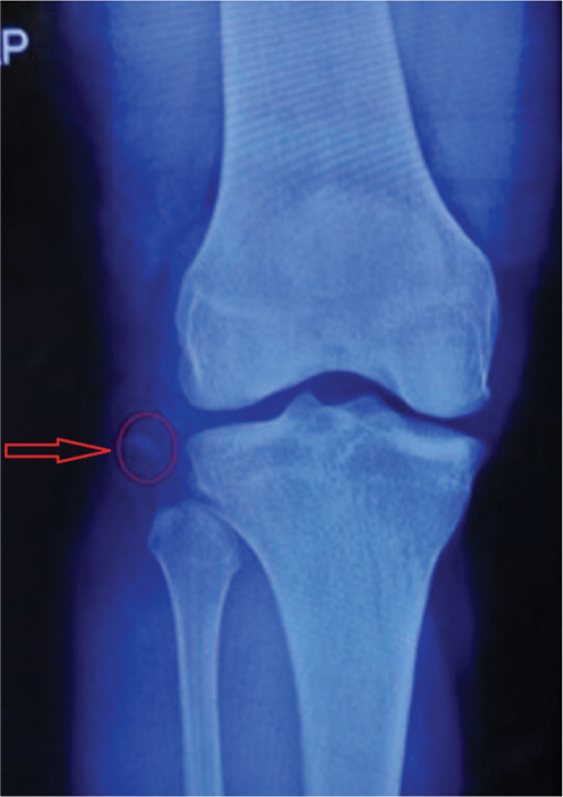 Arcuate complex avulsion marked by arrow.