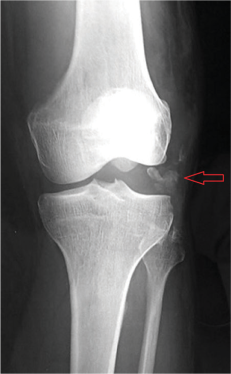 Biceps femoris avulsion marked by arrow