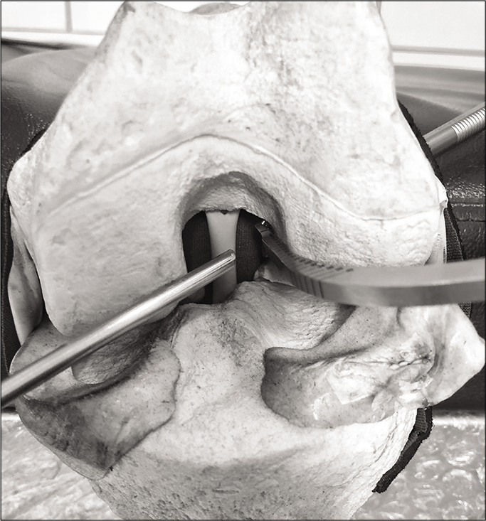 Deep placement of femoral jig leads to frequent clashes with the scope in the tight space of intercondylar notch in anterior cruciate ligament reconstruction.