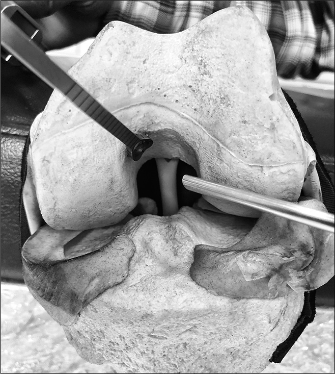 Jig placement, handling and visualization are relatively easier in posterior cruciate ligament reconstruction due to the shallow placement in the notch.